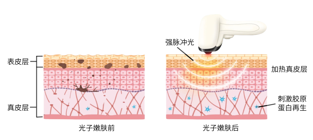 IPL (6)